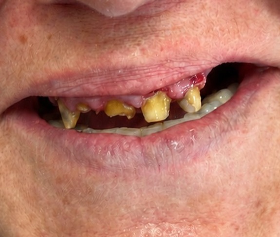Upper metal-ceramic crowns, before
